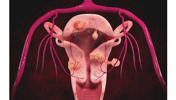 Фото: Интерстициальная миома